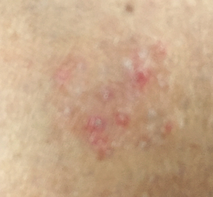 /img/ringworm.jpg